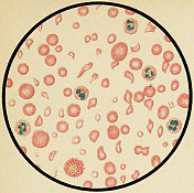 19世纪一例严重贫血患者的红细胞异kilocysis的显微镜观察