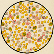 一个慢性粒细胞性白血病患者的血液细胞显微镜观察，用Ehrlich三酸染色- 19世纪