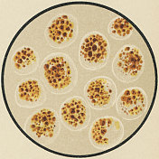 19世纪二尖瓣狭窄患者咳血痰液的显微镜观察