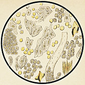 肾盂肾炎患者尿液沉淀物的显微镜观察- 19世纪