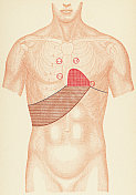 肥厚性心肌病的病人用听诊器和叩诊点的人体躯干的医学说明，正面视图- 19世纪
