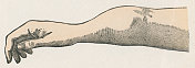 人体手臂上由梅毒引起的骨膜炎的医学插图――19世纪