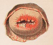 19世纪人类子宫颈颗粒性溃疡的医学插图