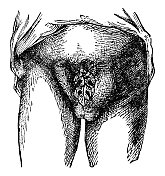 双侧腹股沟疝患者的医学插图- 19世纪
